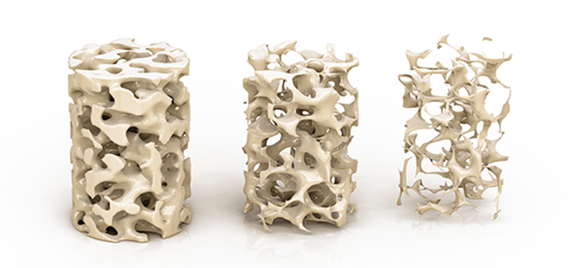 骨粗鬆症について